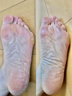 50代 主婦 足裏Before/After